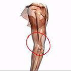 Obat Tradisional Sakit Belakang Lutut